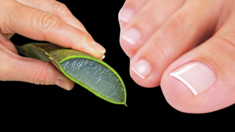 5 unglaubliche Vorteile von Aloe zur sofortigen Beseitigung von Nagelmykose!